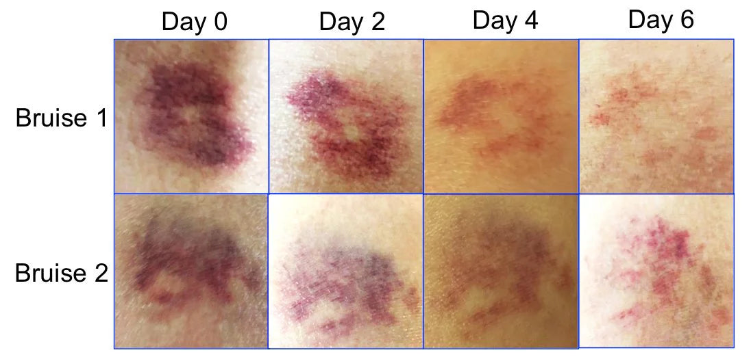 BruiseGONE 3 pack- Sizepeeds bruise healing by ONE WEEK, NO CREAM, Natural bruise remedy